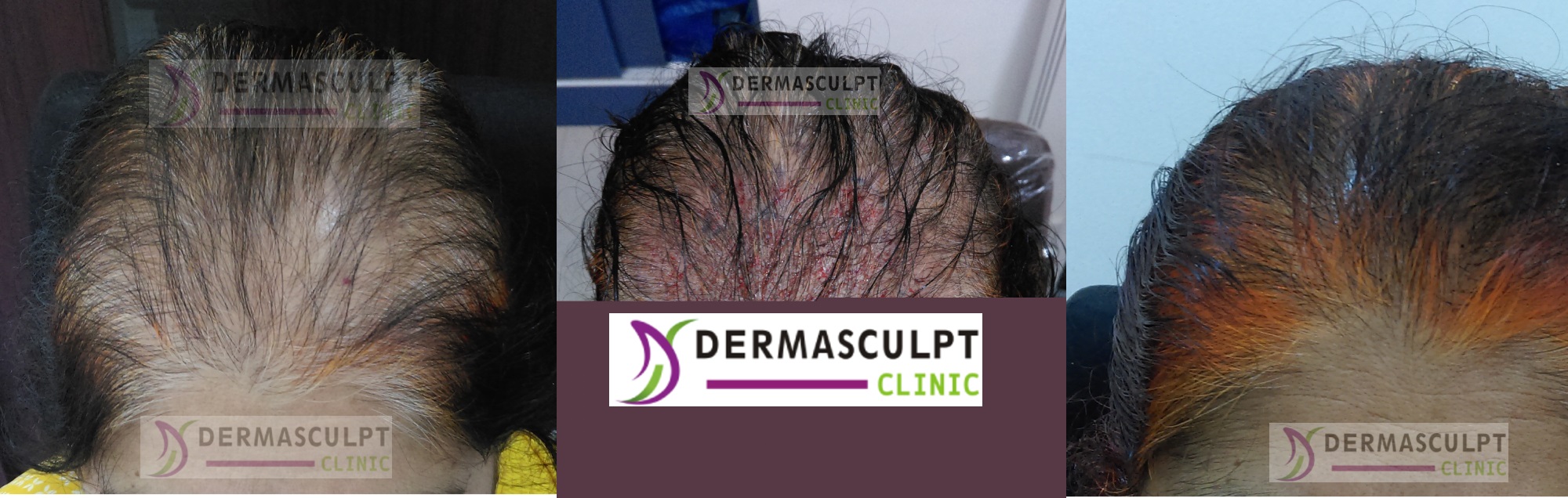 hair-transplant-bangalore